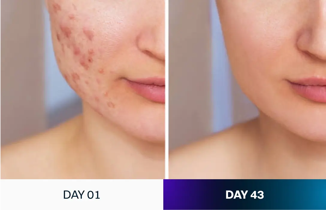 PURWATER™ - THE DERMA SHOWERHEAD (The One Skio)